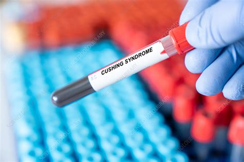 lushings compression test|cushing syndrome blood test results.